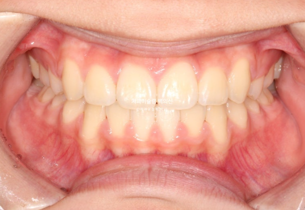 덧니 돌출입 발치교정 상악만 2개 편악 발치 클리피씨 입술부전증 치료 관련 이미지 10