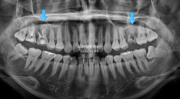 인비절라인 돌출입 발치교정 임플란트 없이 사랑니 대체 관련 이미지 6