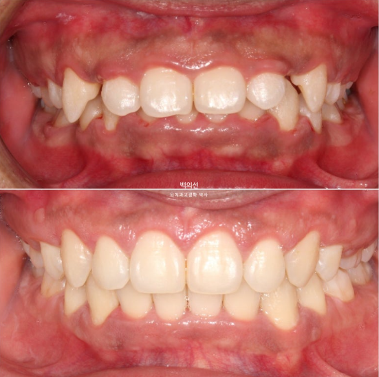 거미스마일 잇몸미소 발치 돌출입 과개교합 교정 후기 관련 이미지 1