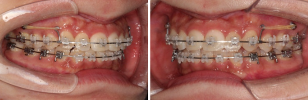 Inward-Tilted Teeth Orthodontic Treatment Review | A Real Case of Treating Congenitally Missing Lower Incisor (Three Lower Front Teeth) Without Extractions image 7