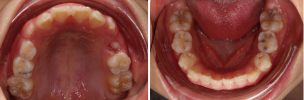 압구정 어린이교정 인비절라인 퍼스트 악궁확장 덧니 교정 관련 이미지 6