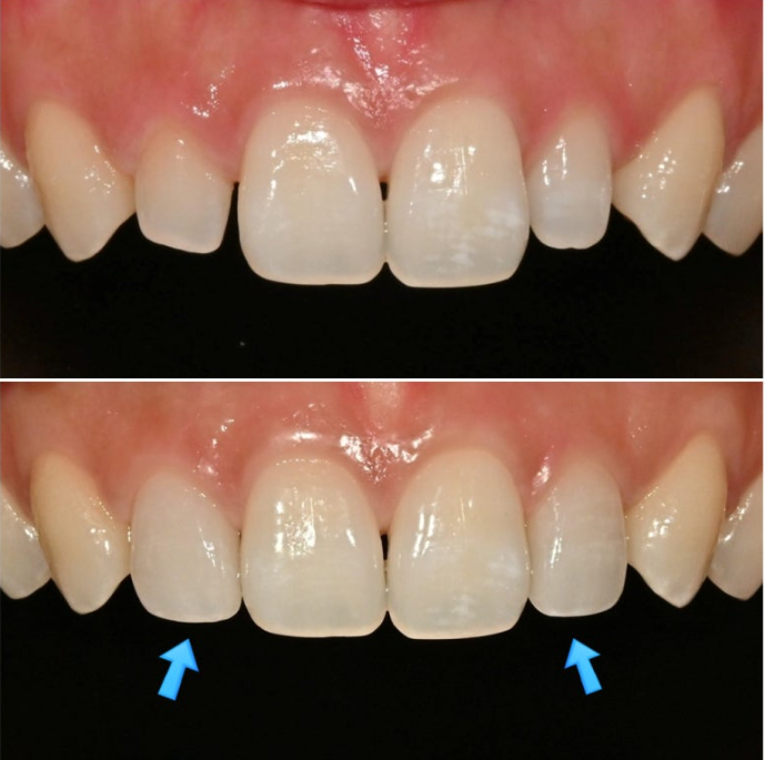 왜소치 반점치 (반상치)가 있는 경우 무삭제 라미네이트 치료 관련 이미지 5