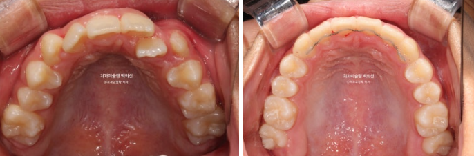 덧니 반대교합 과개교합 인비절라인 퍼스트 악궁확장 어린이 교정 관련 이미지 18