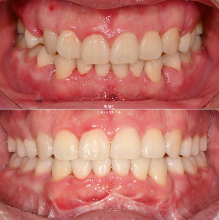 돌출입 수술 ASO + 인비절라인 라이트 후교정 치료기간 10개월 관련 이미지 1