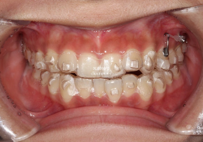 유학생 치아교정 해외거주 한국에서 치아교정? 관련 이미지 7
