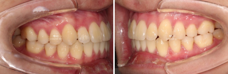유학생 교정 덧니 반대교합 인비절라인 라이트 치료기간 관련 이미지 12