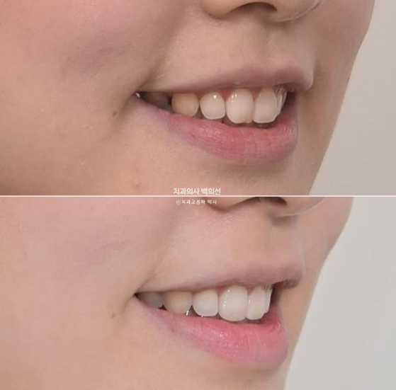 인비절라인 라이트 재교정 발치공간 벌어짐 ? 관련 이미지 13