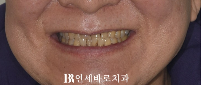 무삭제 라미네이트 하러 왔다가 부분교정을 먼저 한 이유 관련 이미지 2