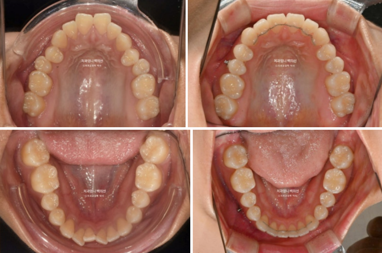 인비절라인 개방교합 교정 어금니 함입 교정 비베라? 관련 이미지 11
