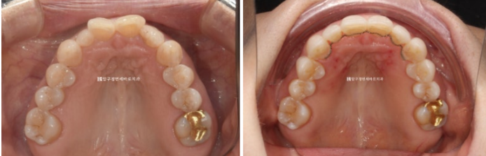 Can It Be Done in Your 50s? Real Results from Limited Front Teeth Orthodontics + No-Prep Laminate Veneers Revealed image 18