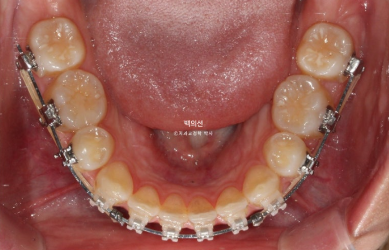 클리피씨 교정에서 인비절라인 변경 마무리 인비절라인 라이트 치료기간 4개월 관련 이미지 3