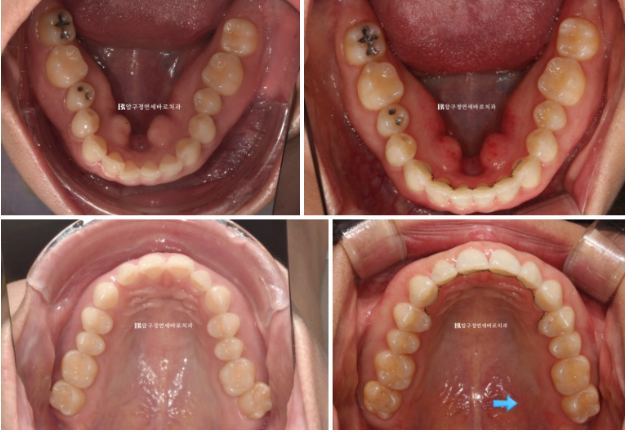 인비절라인 라이트 가위교합 벌어짐 중심선 미니스크류 치료기간 11개월 관련 이미지 11