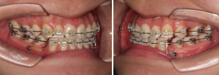 비수술 주걱턱 비대칭 발치 교정 결손치 반대교합 클리피씨 치료기간 1년 11개월 관련 이미지 8