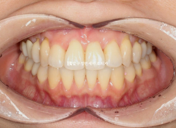 30대 토끼이빨 교정 반대교합 앞니 부분교정 후기 관련 이미지 5