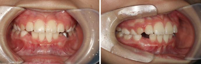 소아 투명교정 인비절라인 퍼스트 후기 기록 관련 이미지 9