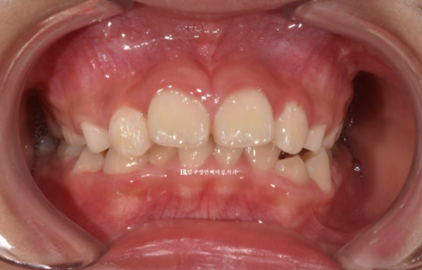 압구정 어린이교정 인비절라인 퍼스트 악궁확장 덧니 교정 관련 이미지 1