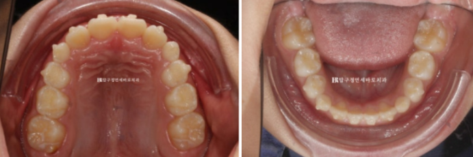 무턱교정 어린이 투명교정 인비절라인 퍼스트 교정 후기 관련 이미지 15