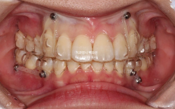 돌출입 교정 인비절라인 발치 교정 후기 관련 이미지 8