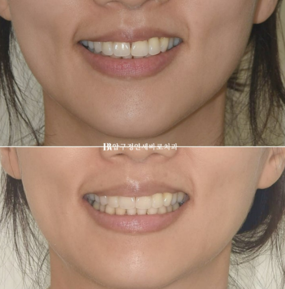 블랙트라이앵글 없애는 교정 가능할까요? 재교정 단기교정 후기 관련 이미지 12