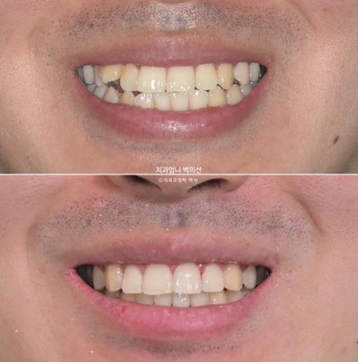 반대교합 비발치 교정 클리피씨 후기 관련 이미지 12