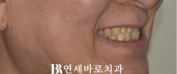 60대 무삭제 라미네이트 앞니 부분교정 치료 관련 이미지 3