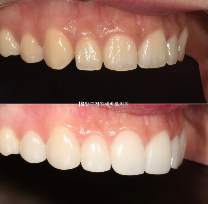 스마일라인 개선 무삭제 라미네이트 실제 두께 ? 관련 이미지 11