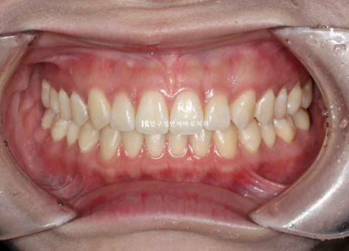 옥니 교정 인비절라인 라이트 옹니 덧니 치료기간 ? 관련 이미지 9