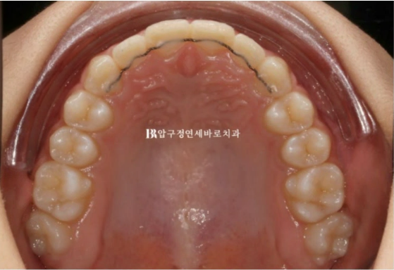 서울 인비절라인 덧니 교정 과개교합 후기 관련 이미지 8