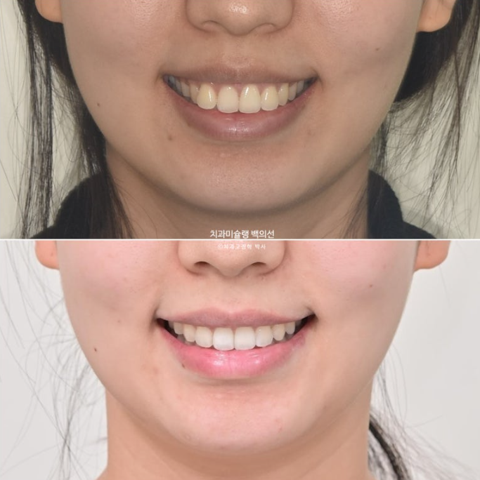 비발치 인비절라인 교정 돌출입 교정 후기 관련 이미지 1
