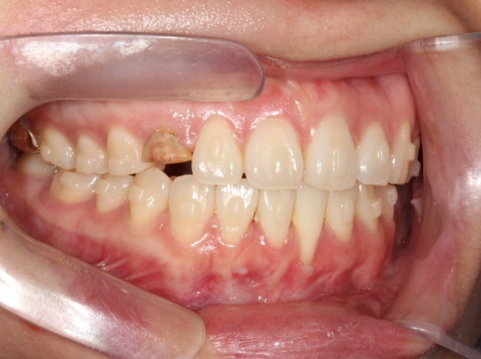 매복 결손 잔존유치 라미네이트 크라운 캔팅 인비절라인 라이트 치료 관련 이미지 11