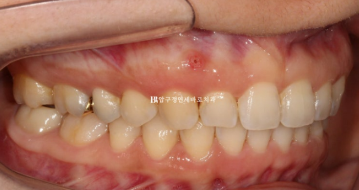 인비절라인 캔팅 교정 과개교합 교정 임플란트 재교정 관련 이미지 9
