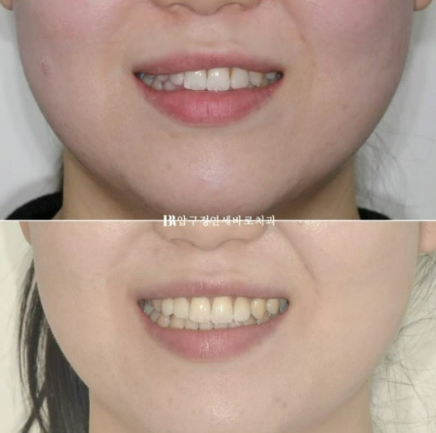 왜소치 치료 잔존유치 무삭제 라미네이트 후기 관련 이미지 11
