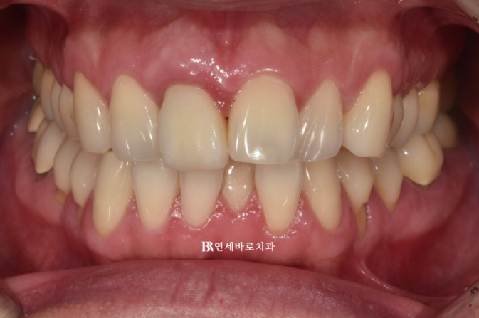 안보이는 앞니 교정 2D 교정 부분교정 후기 / 교정 시 잇몸이 더 나빠지지 않을까요? 관련 이미지 1