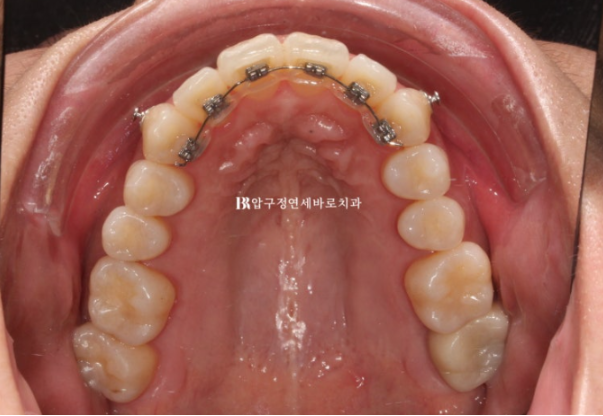 예비신부 교정 단기 앞니 부분교정 치료기간 6개월 관련 이미지 9
