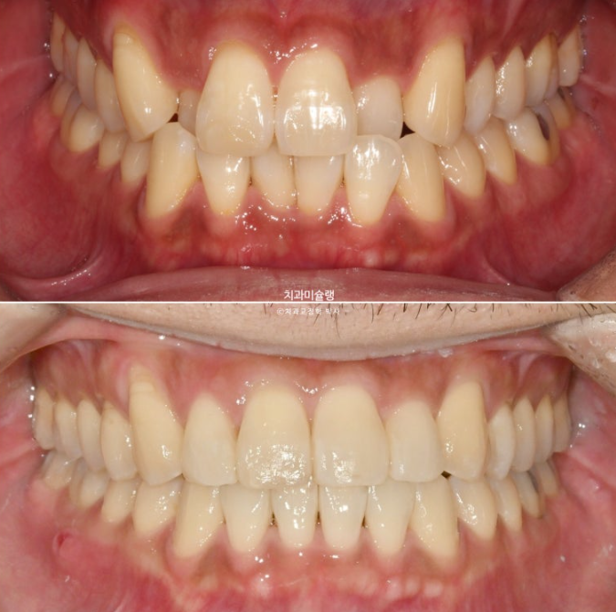30대 MSE 악궁확장 덧니 반대교합 비발치 클리피씨 부작용 관련 이미지 17