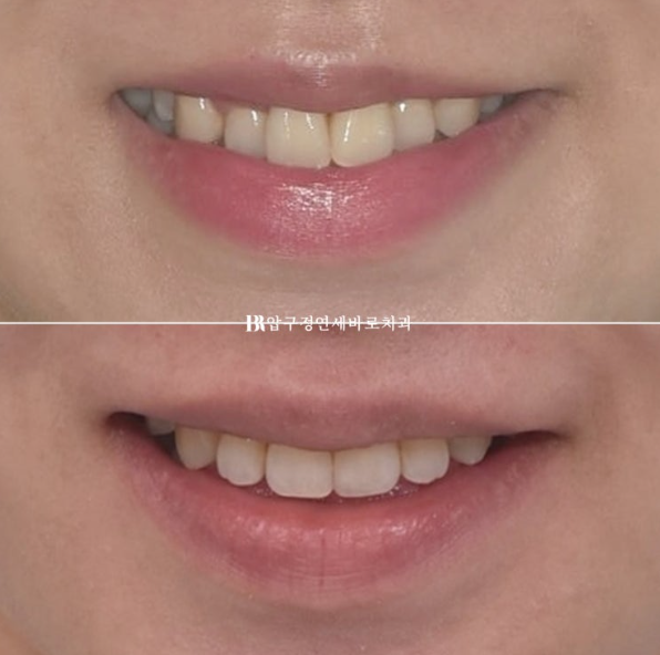 Is compliance important for Invisalign? | A real case that improved reverse bite and scissors bite in 8 months image 13