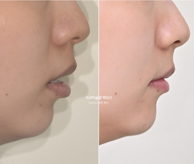 비발치 인비절라인 교정 돌출입 교정 후기 관련 이미지 23