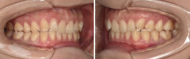 If Inward-Tilted Teeth Make Your Smile Look Constricted? Invisalign Before and After image 3