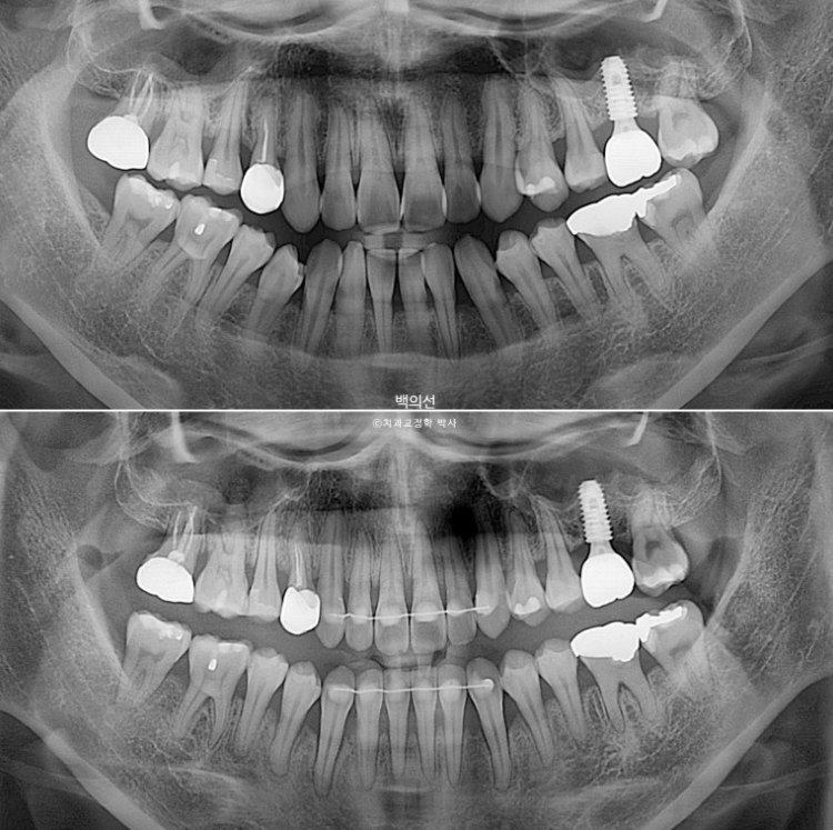 30대 비수술 비발치 주걱턱 부정교합 인비절라인 교정 관련 이미지 18