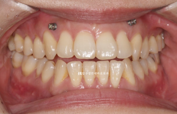 Is Invisalign Treatment Possible After Double-Jaw Surgery? A Real One-Year Case of Surgery-First Orthodontic Treatment image 4