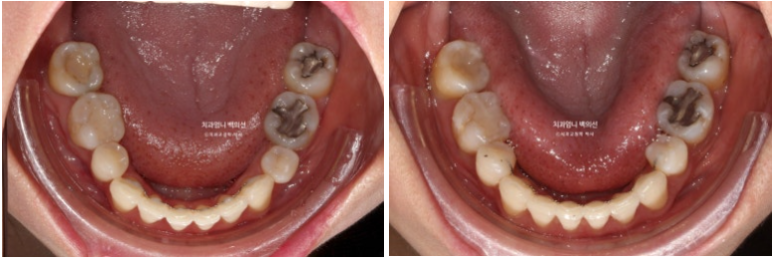 옥니 역교정 재교정 무턱 교정 치료기간 1년 10개월 관련 이미지 16