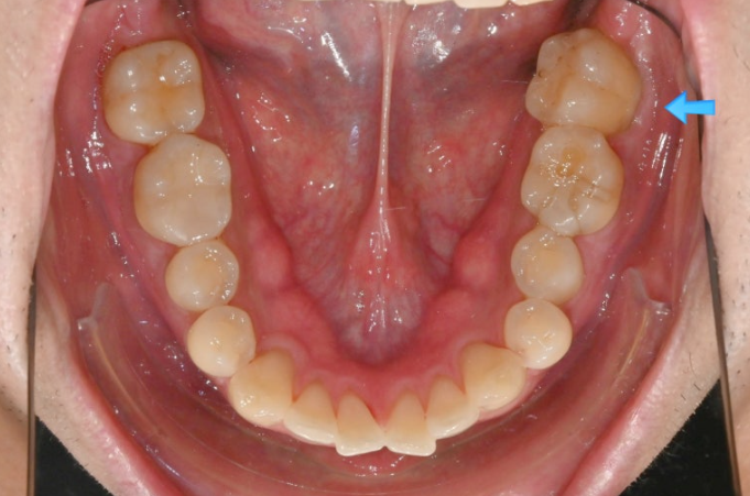가위교합 벌어짐 중심선 과개교합 인비절라인 라이트 교정 관련 이미지 6