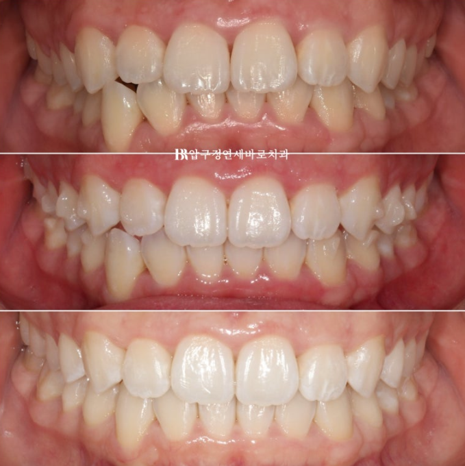 인비절라인 라이트 과개교합 반대교합 돌출입 뻐드렁니 교정 치료 관련 이미지 15