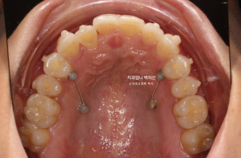 인비절라인 비발치 덧니 교정 반대교합 치료 후기 관련 이미지 7