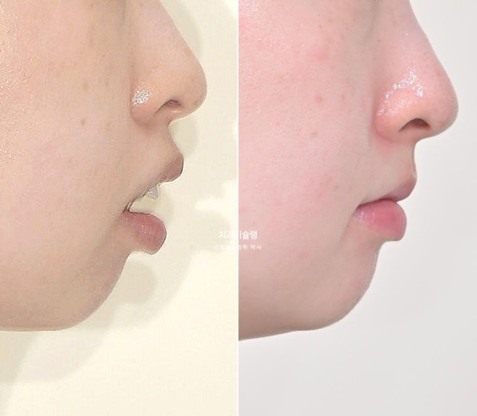 심한 돌출입 입술부전증 호두주름 발치교정 치료 관련 이미지 19