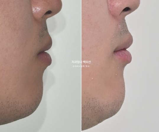 반대교합 비발치 교정 클리피씨 후기 관련 이미지 14