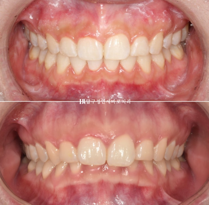 인비절라인 돌출입 발치교정 거미스마일 잇몸미소 교정 관련 이미지 12