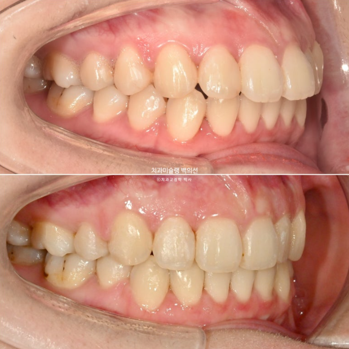 돌출입 인비절라인 발치교정 거미스마일 잇몸미소 잇몸돌출 입술부전증 무턱 재교정 관련 이미지 19