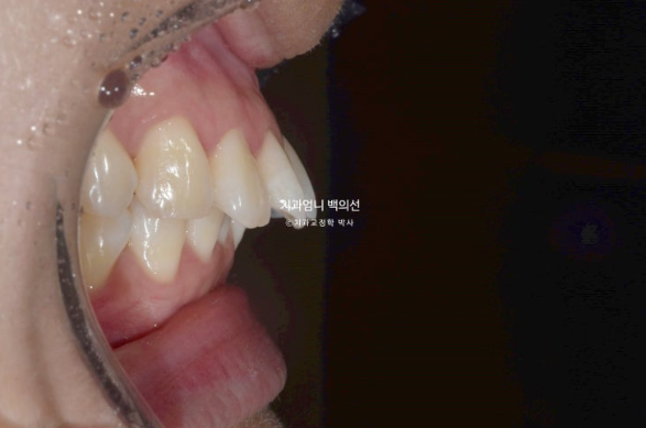 돌출입 교정 인비절라인 발치 교정 후기 관련 이미지 4