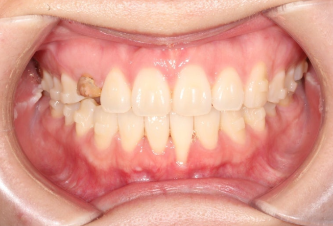 매복 결손 잔존유치 라미네이트 크라운 캔팅 인비절라인 라이트 치료 관련 이미지 10